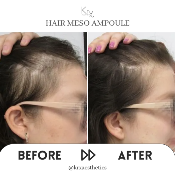 KrX Premium Hair Meso Solution – Bild 3