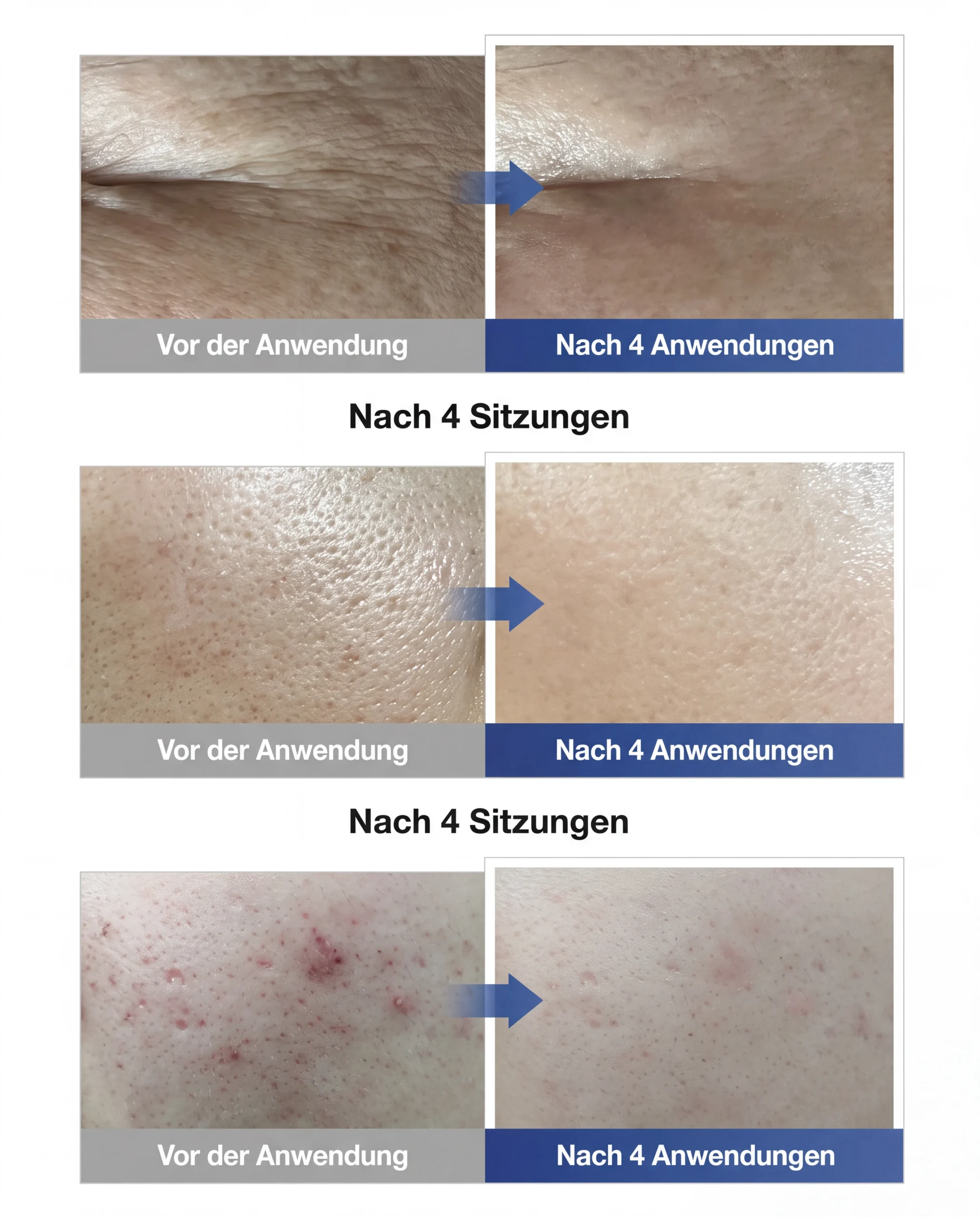 DERMATHOD EGF Multi Effector Ampulle Vorher-Nachher nach vier Anwendungen